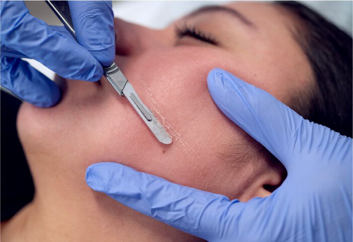 How does dermaplaning works?