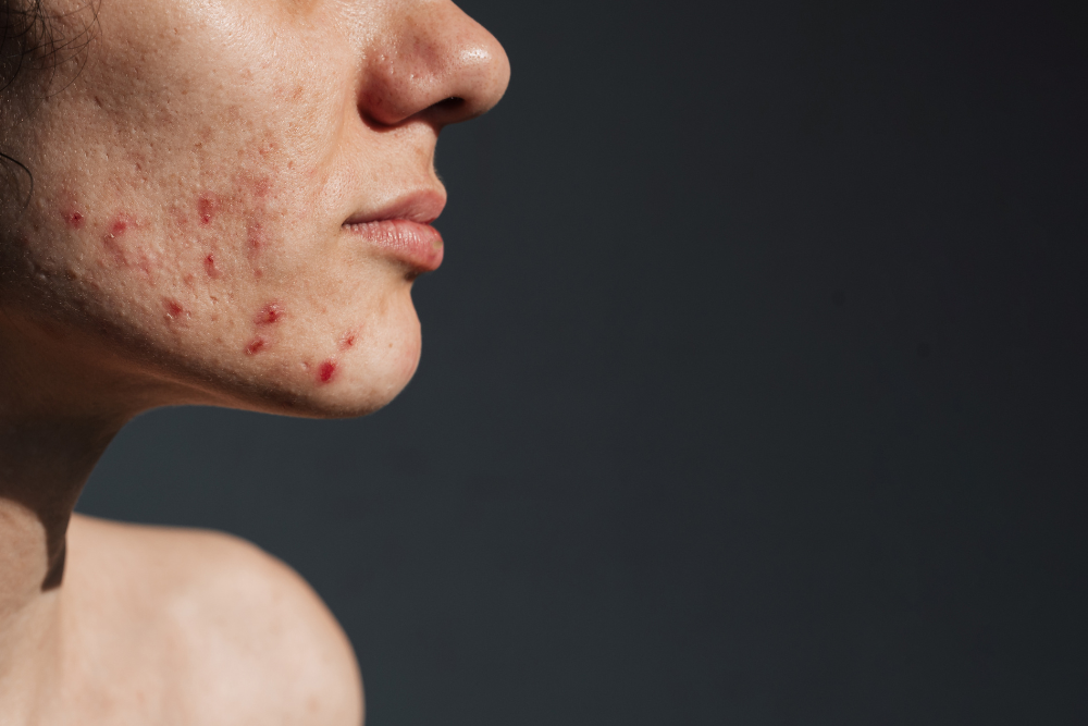 How to get rid of Acne & Acne scarring at Nuyu Cairns